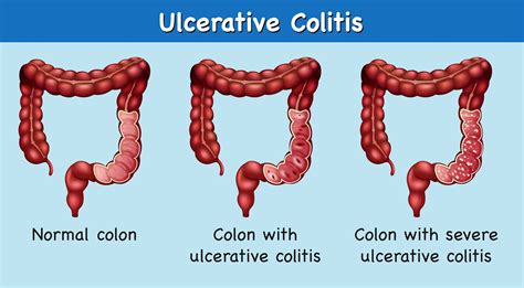 ulcerative colitis dating site